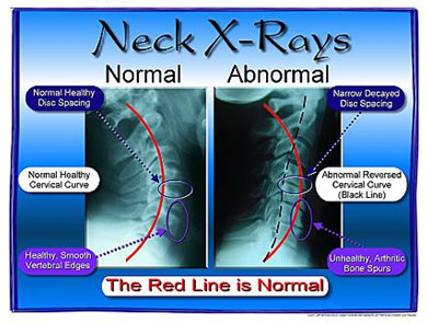 Image result for normal cervical xray